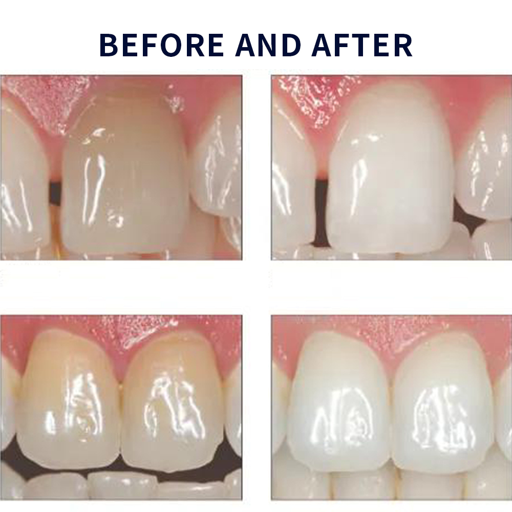 Opale scence White ning 1,2 pf – Teeth Whitening Gel Peroxide Bewertung und Preis