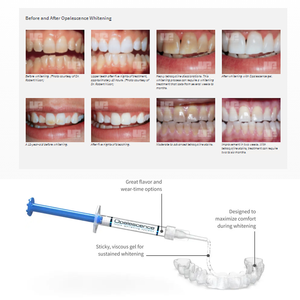 Opale scence White ning 1,2 pf – Teeth Whitening Gel Peroxide Bewertung und Preis