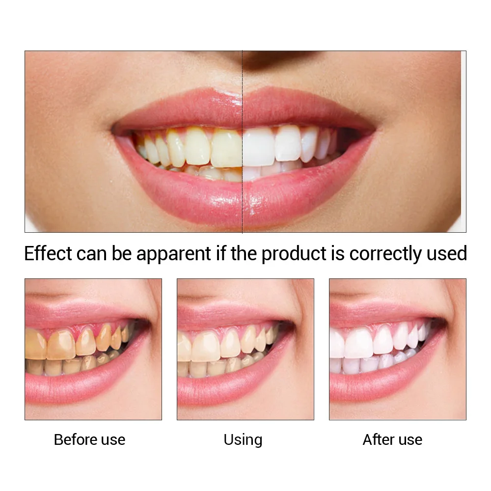 FTEENPLY Zahnaufhellung Essenz – Teeth Whitening Procedure Bewertung und Preis