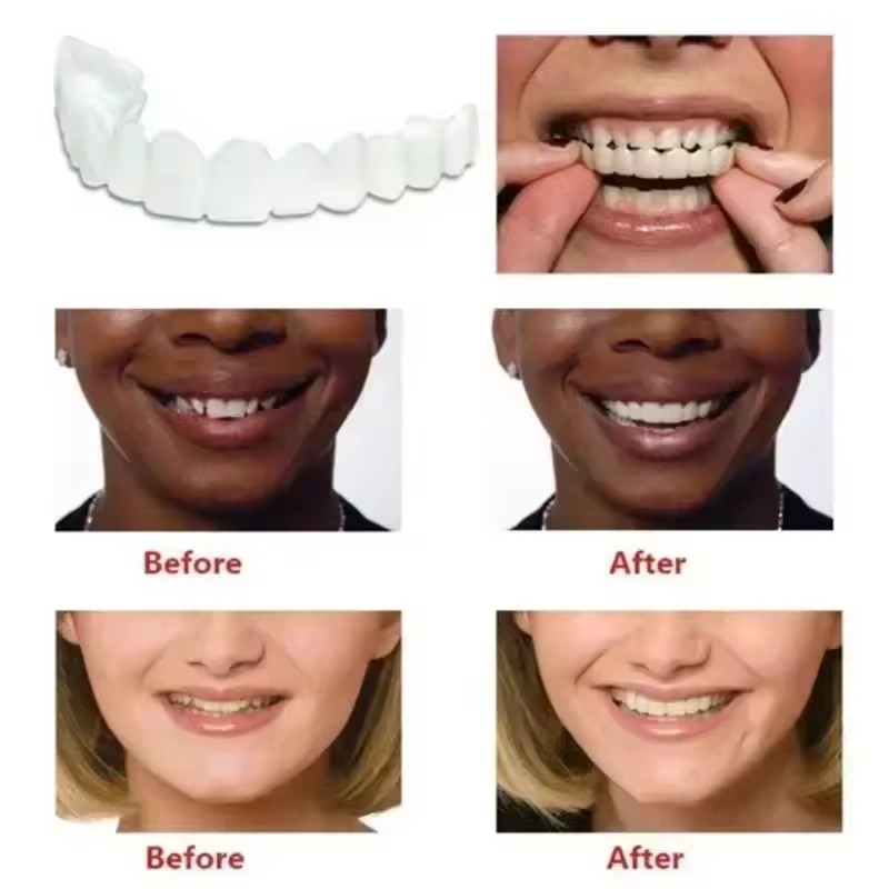 Zahn-Veneers Zahnaufhellung Za – Teeth Whitening Procedure Bewertung und Preis