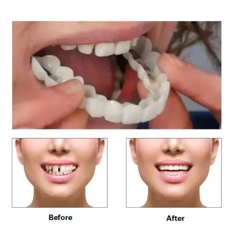 Zahn-Veneers Zahnaufhellung Za – Teeth Whitening Procedure Bewertung und Preis