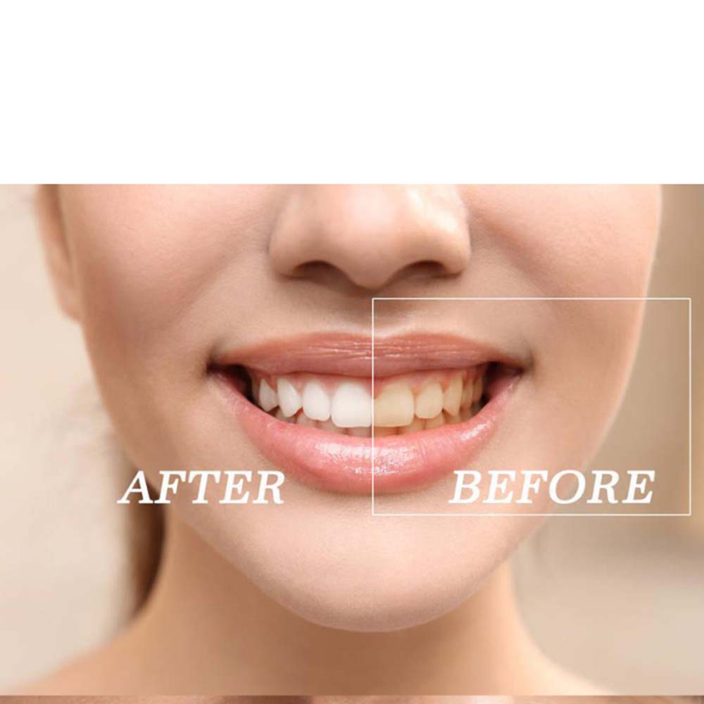 Hochwertiges Peroxid-Zahnaufhe – Teeth Whitening Gel Peroxide Bewertung und Preis