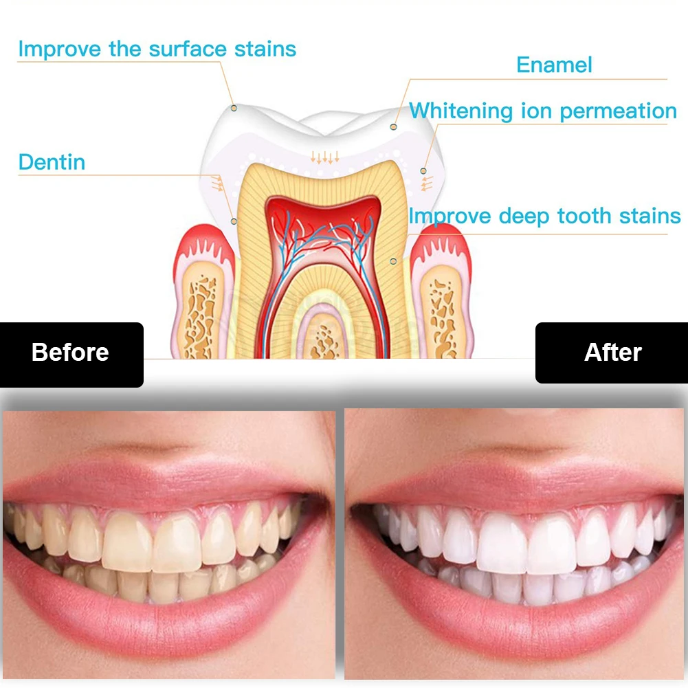 Dental Zahnaufhellung Kit Mini – Teeth Whitening Procedure Bewertung und Preis