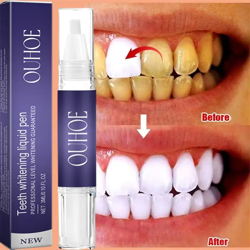 Schnelle Zahnaufhellung Zahnpa – Whitening Pen Bleach Bewertung und Preis